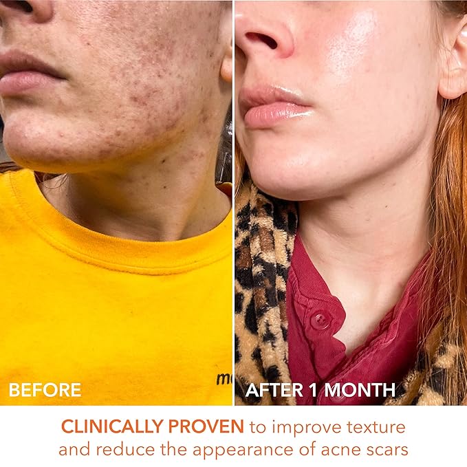 Dr. Dennis Gross Alpha Beta Universal Daily Peel: for Uneven Tone or Texture and Fine Lines or Enlarged Pores, (60 Treatments)